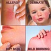 QUATRIDERM Fast Relief Hydrocortisone Cream for Eczema Itch Inflammation Aloe