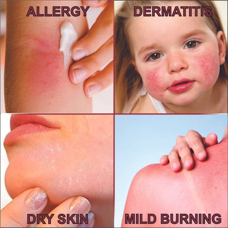 QUATRIDERM Fast Relief Hydrocortisone Cream for Eczema Itch Inflammation Aloe