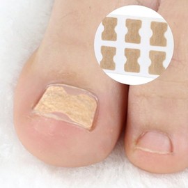 Ingrown Toenail Correction Tape Pack of 10 20ea