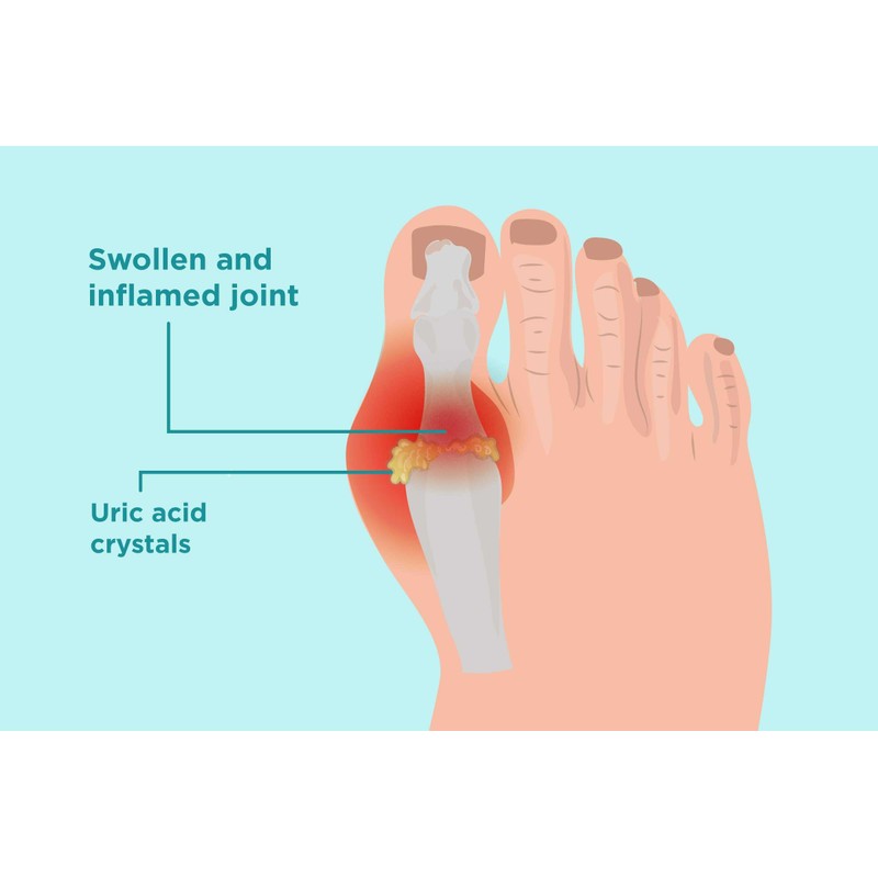 Uric Acid Gout Urine Test Strips GP/Pro Use CE Marked