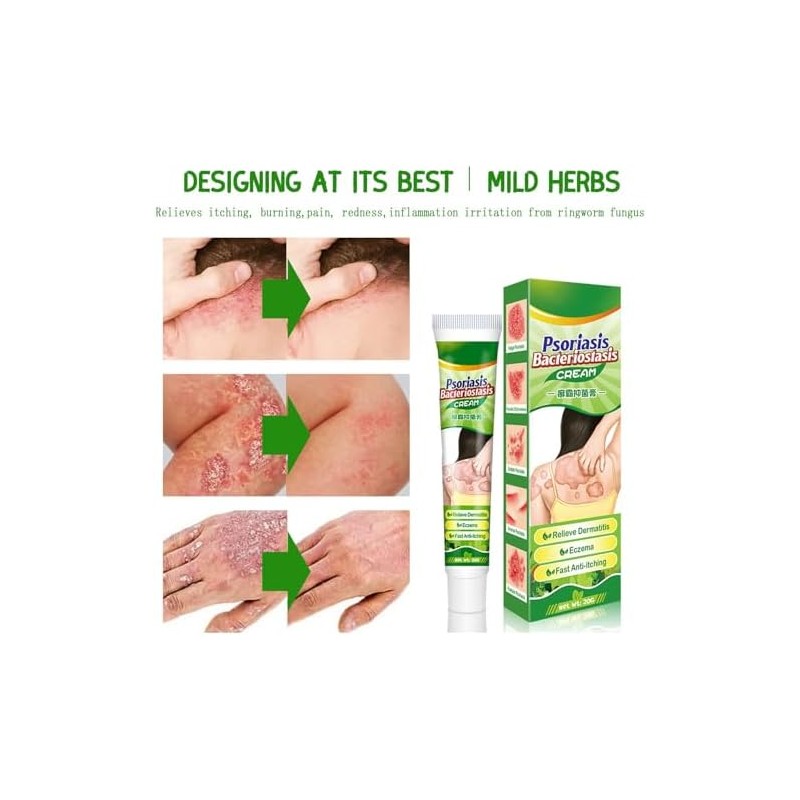 Crema Natural A Base De Hierbas Antipicazón, Crema Para Psoriasis