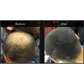 Hair Loss Concealer - Black 8g (12 Day Supply)