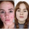 On Cream for acne, spots and wrinkles on the face.
