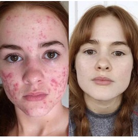 On Cream for acne, spots and wrinkles on the face.