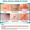 Extra Long Silicone Scar Sheets (1.6” x 200” Roll-5M), Silicone