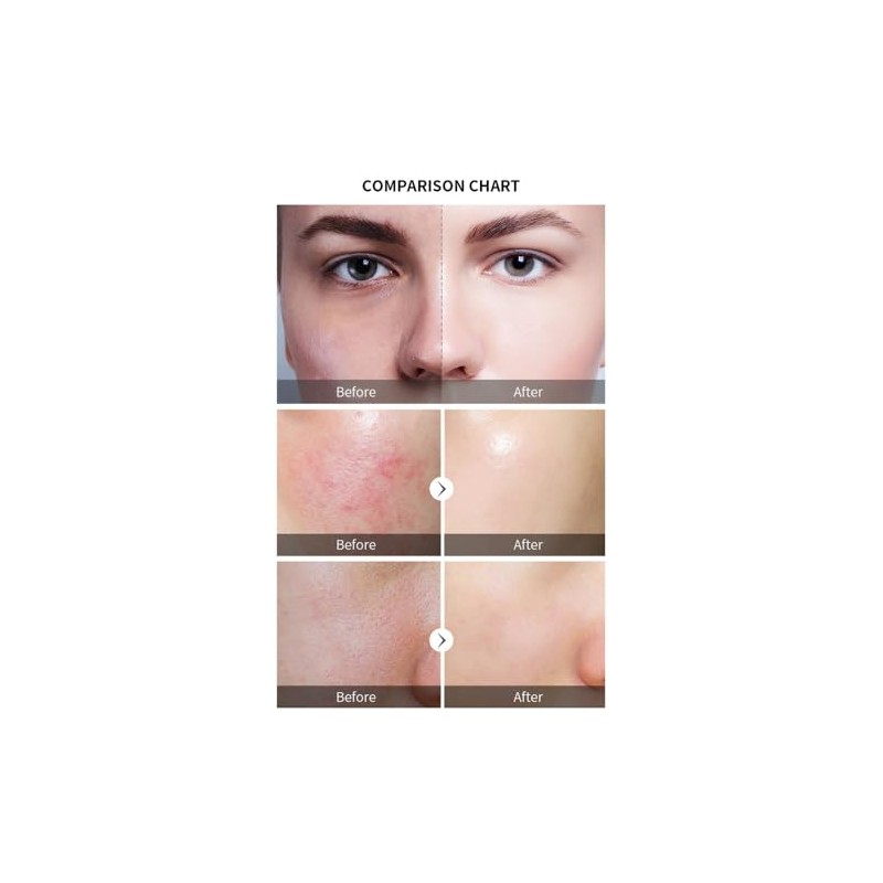 TFixol Solución Exfoliante con 30 ml de AHA 30 BHA