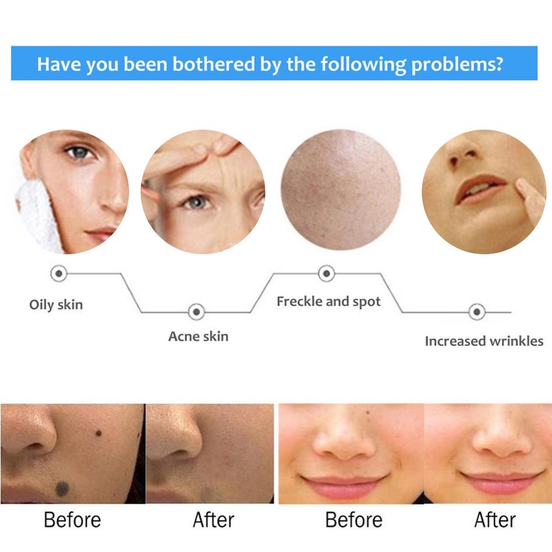 Ultrasonic Freckle Spots Removal Machine Detoxifying Face Care Machine for