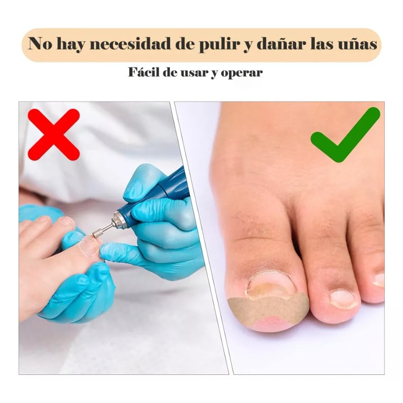 Dolores Kit Pedicure Corrector Uña Tratamient Enterradas Herramienta