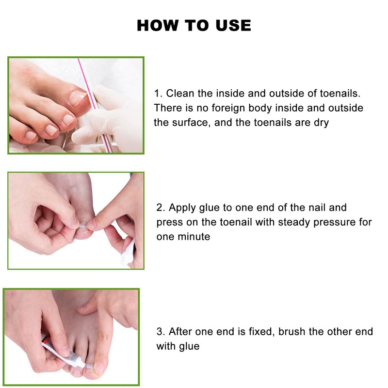10pcs Toenail Correction Strips Brace Elastic Change Growth Direction Ingrown