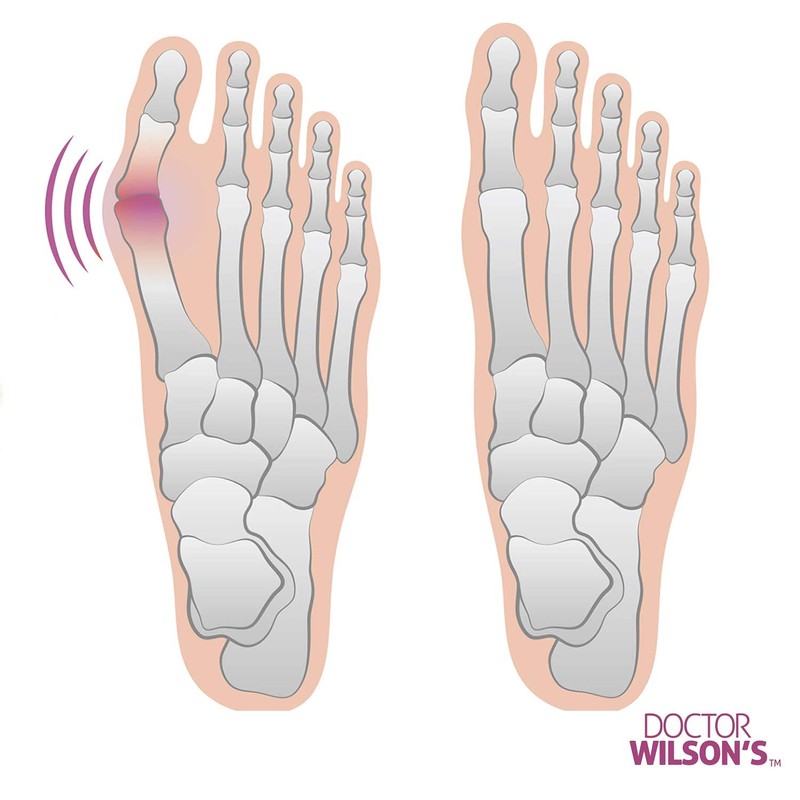 2 Bunion Relief Pads Sleeve - Bunion Splint Orthopedic Bunion