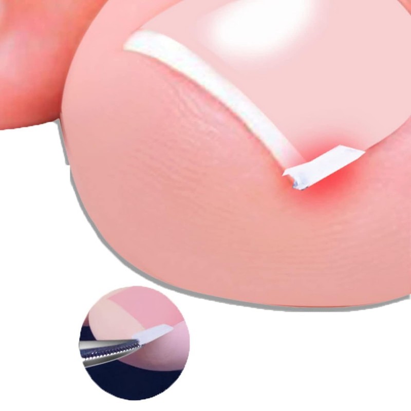 10 Pcs Ingrown Toenail Correction Strips Brace Kit, Ingrown Toenail