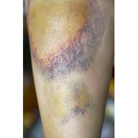 Arnica Ointment 60ml Handmade In Yorkshire