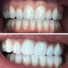 HeySmile Teeth Whitening Strips - No Sensitivity - Instant Results