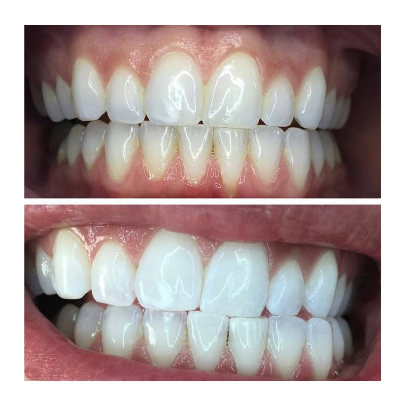 HeySmile Teeth Whitening Strips - No Sensitivity - Instant Results