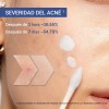 Dr.leo Acne Buster Loción Secante Con Ácido Salicílico
