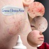Crema Cicatrices Poros Control De Grasa Acne Cream 2pz Full