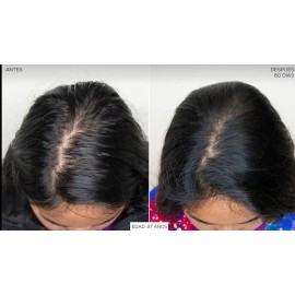 Locion Fortificante Para Caida Y Crecimiento Del Cabello