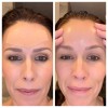 True Beauty Skin Expert Kinesiology Tape For Face Wrinkle Reducer
