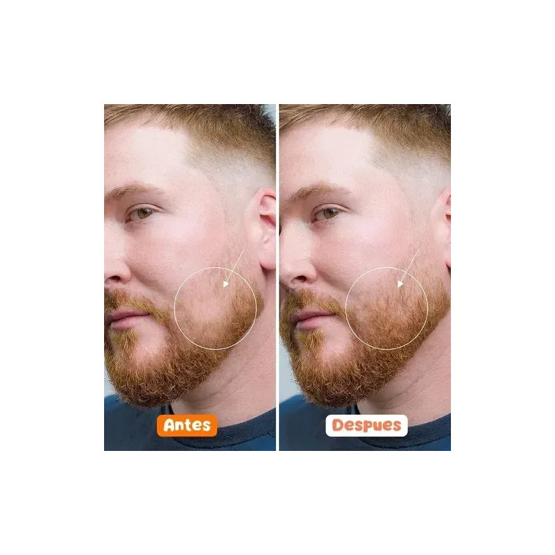 Kit Barba Serum Natural + Rodillo Micro Agujas Crecimiento