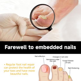 Nagel Oil, 30ml Nagelpflege, Eingewachsene Zehennägel Tropfen, Natural Ingrown Toenail Correction Oil, Nail Essence Serum, Nagelpflege Serum für Brüchige, fur Gebrochene und Verfärbte Nägel