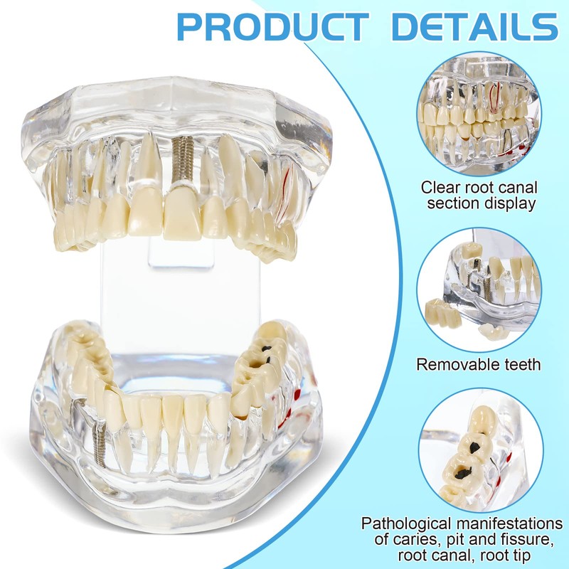 Outus Disease Teeth Model Dental Typodonts Implant Teeth Model with
