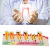Caries Model Dental Caries Model, Model Teeth Teaching Dental Gum