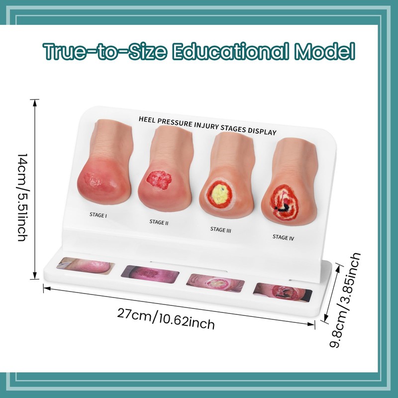 MedEduQuest Heel Pressure Injury Stages Model, Ulcer Demonstration Model
