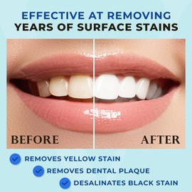 Venus Visage Award Winning Teeth Whitening Pen, 20+ Uses - Teeth whitening Kit Professionally formulated - Best Teeth whitening Gel Pen Teeth Whitener - Low Sensitivity (Mint) (0.07 Fl Oz (Pack of 2))