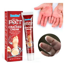 Xt ! Crema Anticongelante Anticongelante For Manos Y Pies /