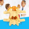 1:1.5 Anatomical Medical Human Spine Lumbar Disc Herniation Demonstration Model