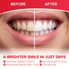 Whites Beaconsfield Teeth Whitening Strips, 60 Strips (30-Day Treatment) –