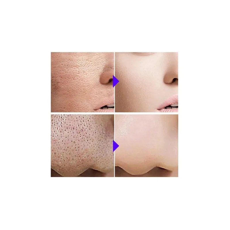 Set 3 pasos antiacné: sérum, crema y mascarilla con ácido