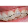 10 Ceras Para Brackets Ortodoncia Dental Borgatta