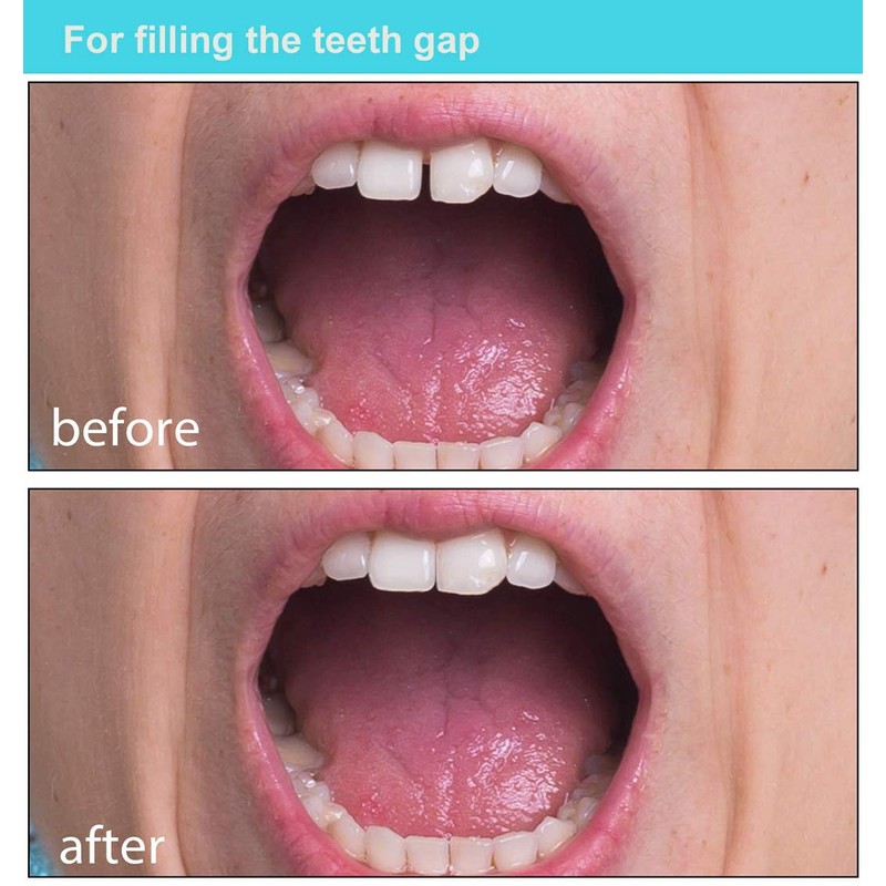 Brige Tooth Repair kit for Filling The Missing Broken Tooth