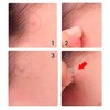 Leafcare Co. 2 pack con 36 pzs, Patch anti acne,