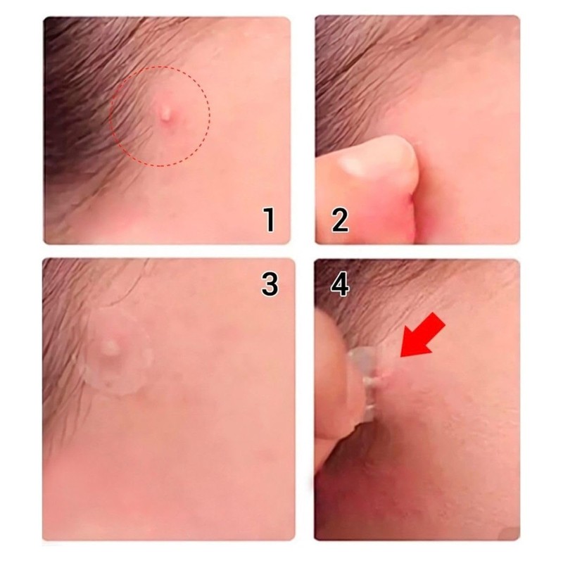 Leafcare Co. 2 pack con 36 pzs, Patch anti acne,