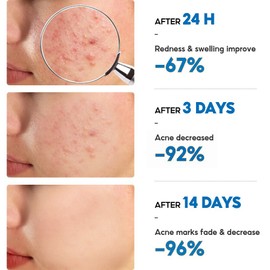 No Brand Acne Cream Acne Treatment Gel Repair Acne Anti Acne Spots Face Repair Comedone Skin Care Acne Removal Gel祛痘膏祛痘霜