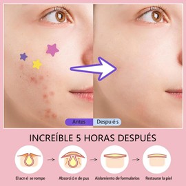 Parches Hidrocoloides para Acné Estrellas - 300 PCS，Parches Absorbentes Invisibles, Reparación Rápida de Espinillas, Impermeables，Formas Adhesivas para Piel Sensible y Todo Tipo de Piel