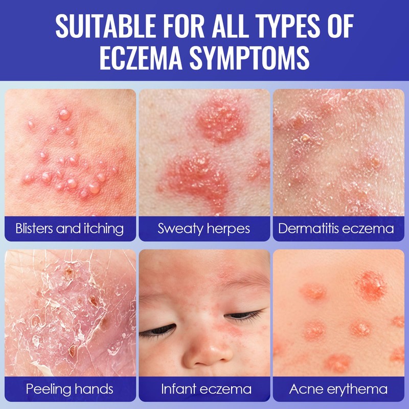100g Eczema Cream, Skin Soothing Cream, Gentle Barrier Cream