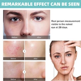 Crepe Be Gone Body Souffle,Crepey Skin Repair Treatment,Face Tightening Cream,Anti Aging Face Cream,Face Moisturiser,Crepe Skin Firming Cream,Crepey Skin Repair Neck Cream,Tightening Sagging Skin