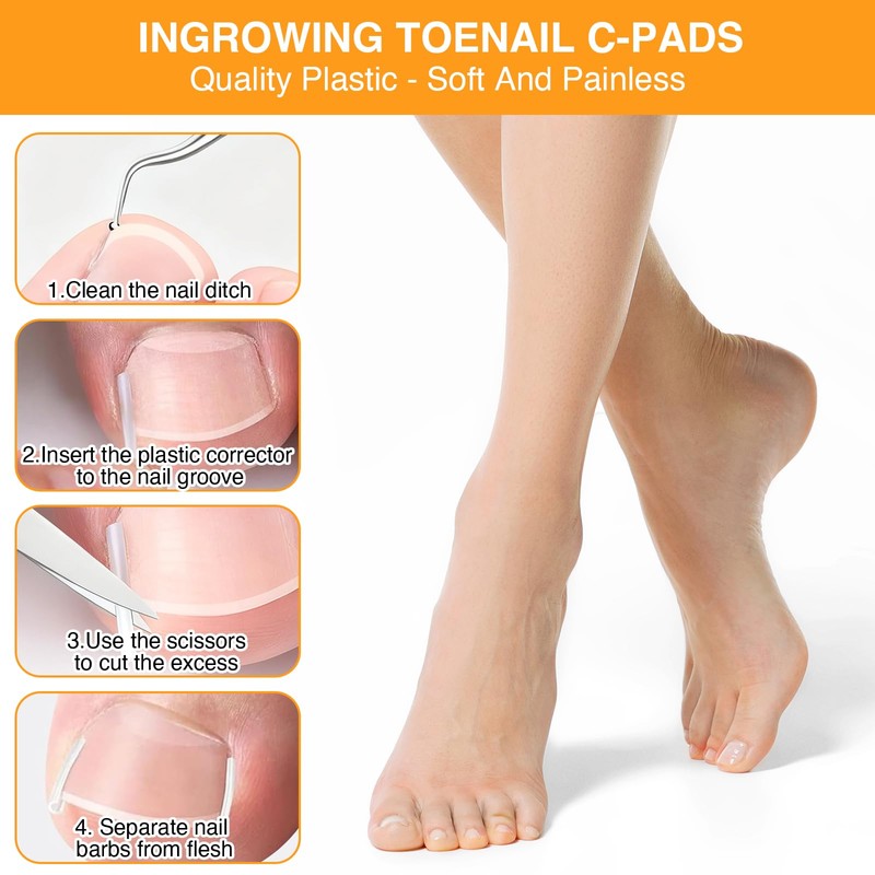 Benaewa 118 Pcs Ingrown Toenail Treatment Kit, Includes Ingrown Toenail