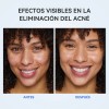 Dr.leo Acne Buster Loción Secante Con Ácido Salicílico 2pzs Todo