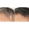 120 parasite and candida cleanse - ANTI-GRAY HAIR - ANTI-PARASITE