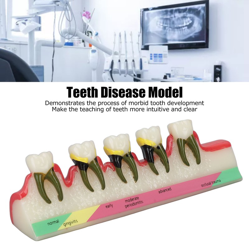 Dental Teeth Model Ceramic Clear Structure Oral Care Educational Periodontal