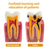Dental Caries Teeth Model, 3.4 x 3 x 2 Inches