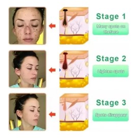 I Gel Exfoliante Quarxery, Gel Exfoliante Suave, Paquete De