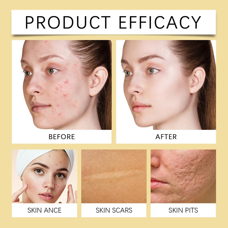 Facial Acne Care Gel (2)