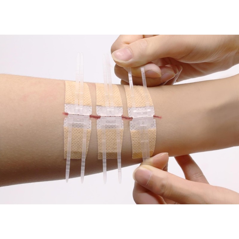 Laceration Wound Closure Device, Emergency Laceration Closure Strips to Repair