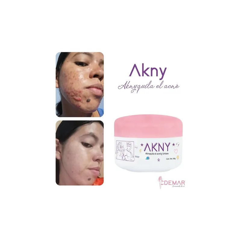 Akny Crema Para Eliminar Acné
