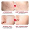 Crema Limpieza Facial Ácido Salicílico